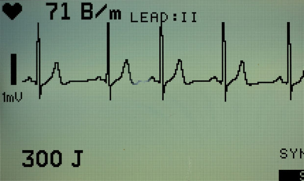 heart failure deaths...