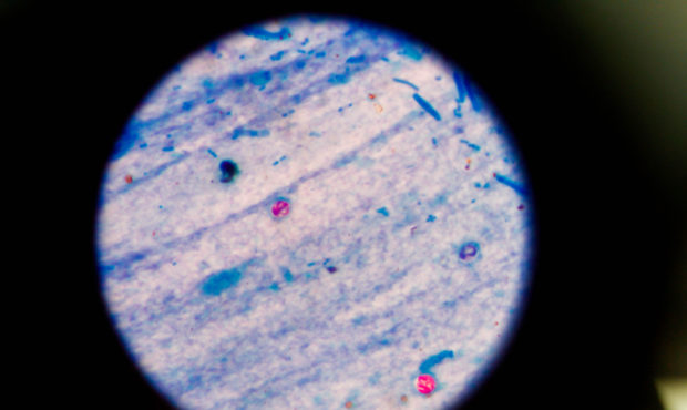 intestinal parasite...